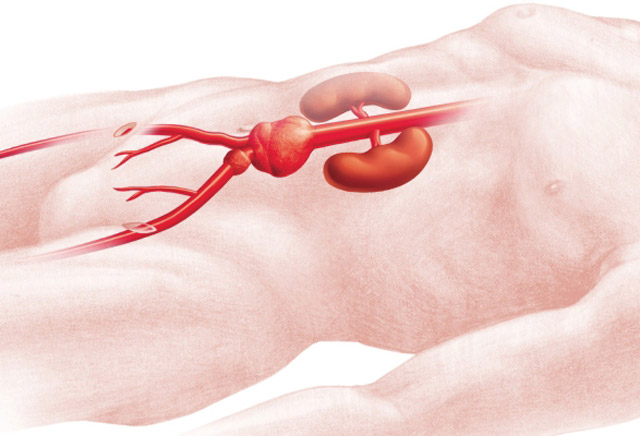 ANEYRISMA KOILIAKHS AORTHS